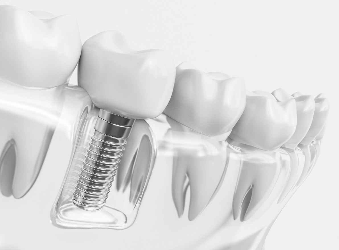 Prothèse dentaire implantée